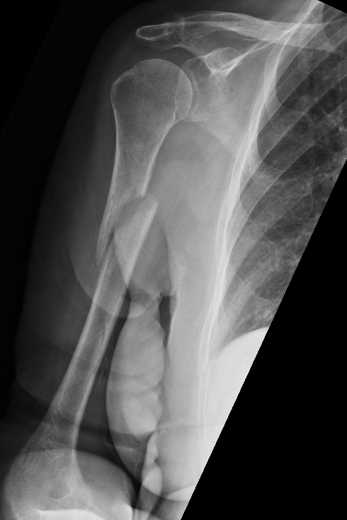 Prox humerus 1